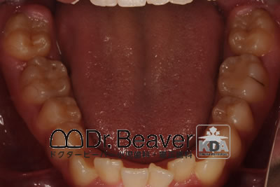 12歳女児歯列から内側に飛び出している歯を歯列に取り込み治した症例（第一期治療のみ） | ドクタービーバー小児歯科・矯正歯科